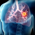 Best Lung Cancer Surgery and Treatment in Delhi India – Dr. Pallavi Purwar
