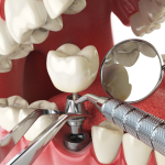 Looking for full mouth dental implants in Hyderabad