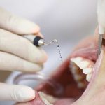 Salinas Dentist | Root Canal Treatment
