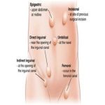 The Best Hernia Surgeon in Delhi NCR